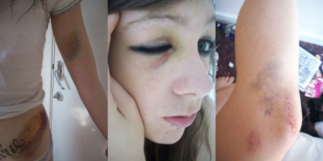 Amy's Bruises